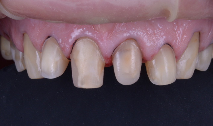 Close-up of upper front teeth with worn and uneven edges and visible gum tissue