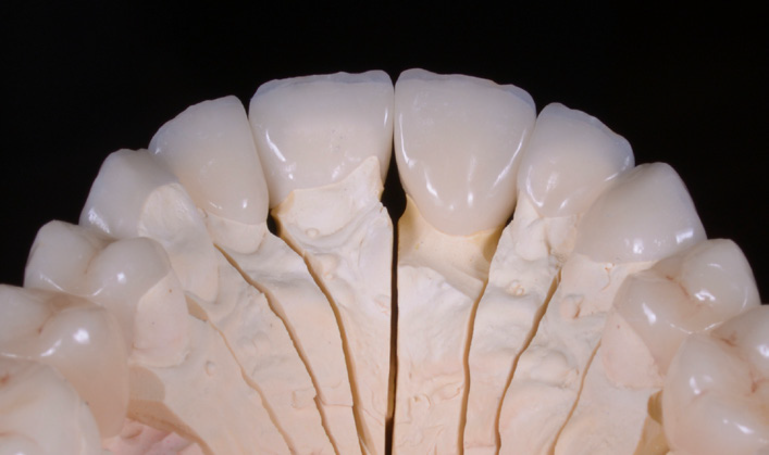 Close-up of a dental model showing upper front teeth with visible cracks and fractures