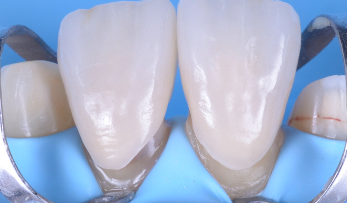 Close-up of four upper front teeth with metal dental clamps and a blue dental dam in the background