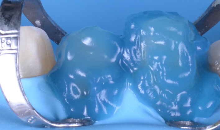 Close-up of two teeth covered with blue dental dam held by metal clamps