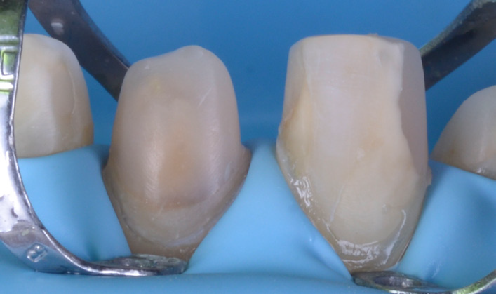 Close-up of two upper front teeth isolated with a blue dental dam and metal clamps