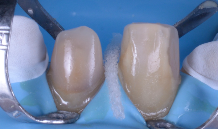 Two upper front teeth isolated with a blue dental dam and metal clamps