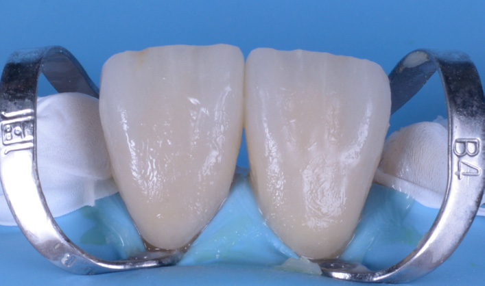 Two upper front teeth isolated with metal clamps and dental dam for treatment