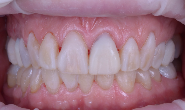 Close-up of upper and lower front teeth showing slight gum inflammation and mild crowding
