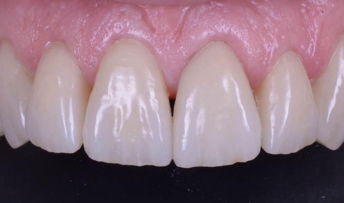 Close-up of upper front teeth and gums showing natural texture and slight translucency