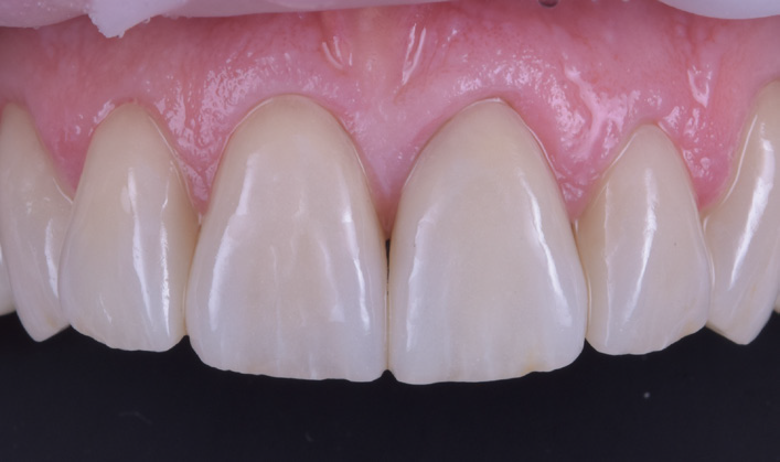 Close-up of upper front teeth showing a chipped incisor with surrounding healthy gums