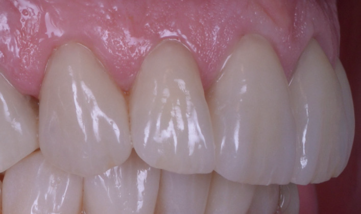 Close-up of upper and lower front teeth showing natural texture and slight translucency