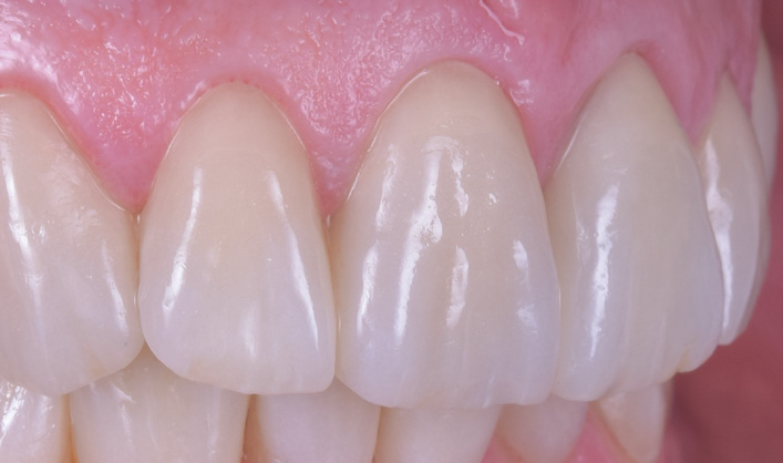 Close-up of upper front teeth showing natural shape and texture of enamel and gums