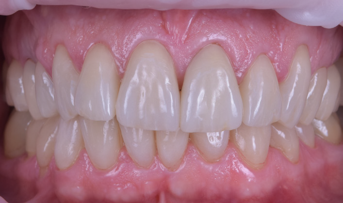 Close-up of upper and lower front teeth with visible gums