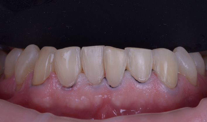 Close-up of upper front teeth showing slight wear and uneven edges