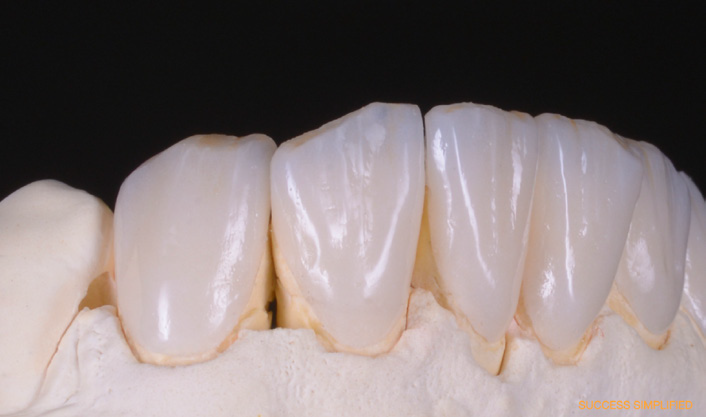 Close-up of a dental model showing five upper front teeth with detailed surface texture