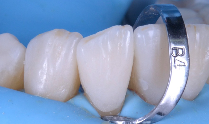Close-up of dental crowns on molars with a metal ring marked 'B4' around one tooth