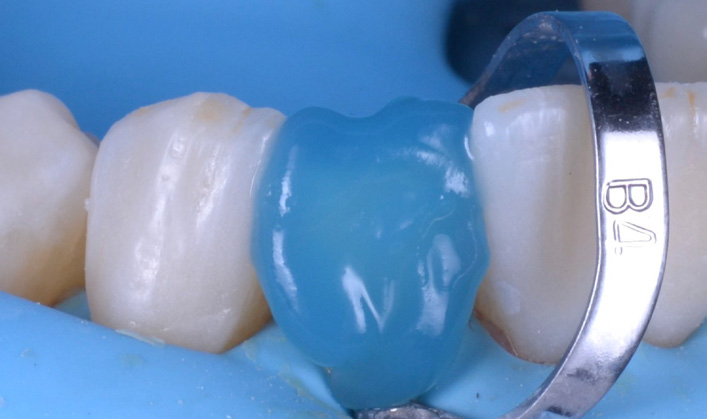 Close-up of a dental procedure showing a blue dental dam and a metal clamp around a tooth
