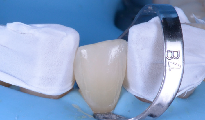 Dental crown placed between two white dental dams with a metal clamp labeled 'B4' on the right side