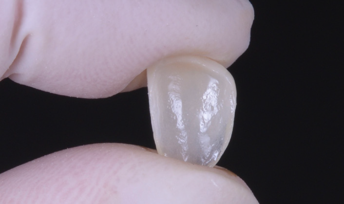 Gloved hand holding a translucent dental veneer between thumb and forefinger against a black background