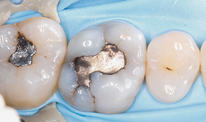 Close-up of molar teeth with dental fillings and a blue dental dam around them