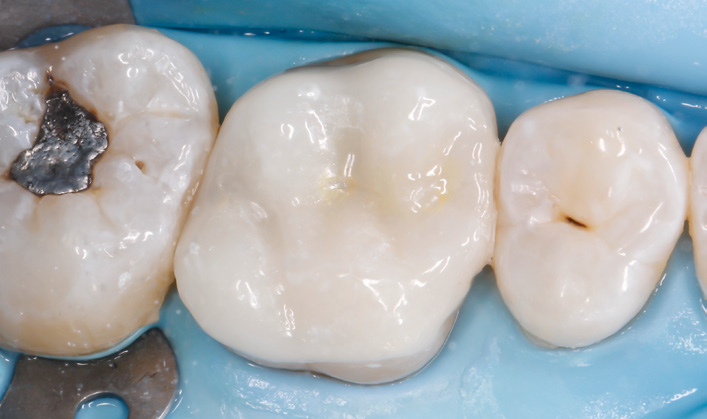 Close-up of three molar teeth with dental dam and metal clamp, one tooth has a silver filling