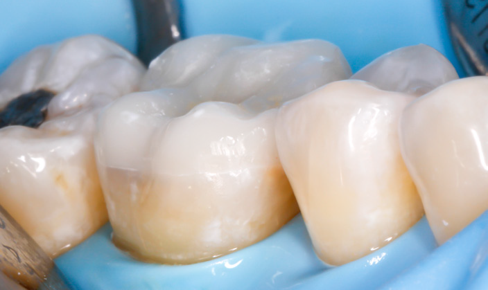 Close-up of dental crowns on molars with a blue dental dam in the background