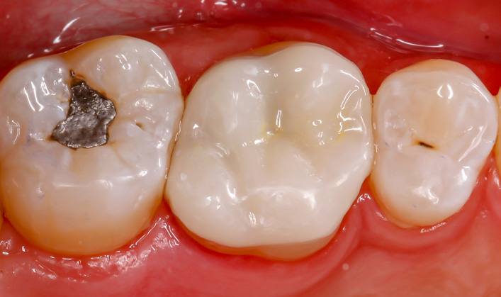 Close-up of three molars with one having a silver dental filling and the others showing natural tooth surfaces