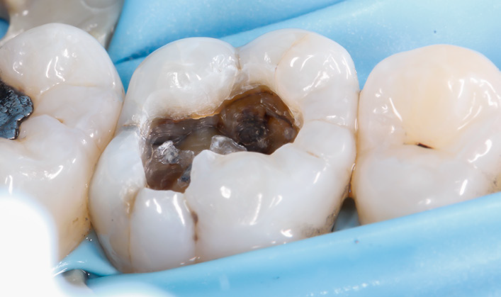 Close-up of molar teeth with one tooth showing a large cavity and dental decay