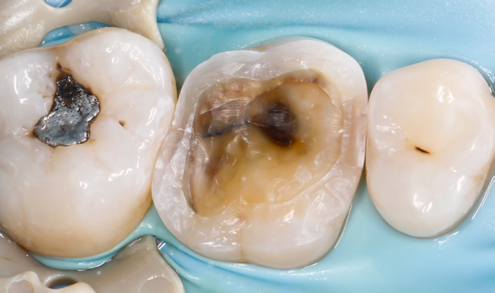 Close-up of three molars with one showing a large cavity and another with a metal filling