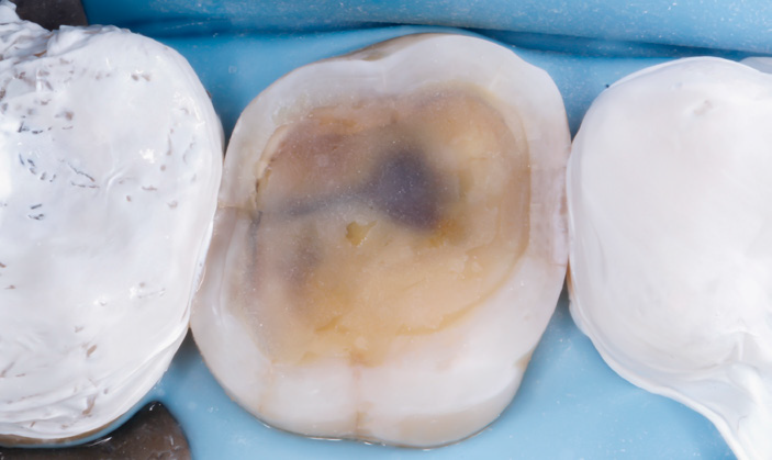 Close-up of a tooth with a large cavity between two white dental molds on a blue background