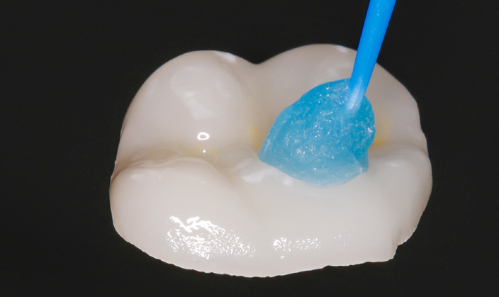 Dental crown with blue applicator applying gel on its surface