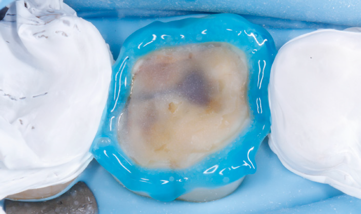 Tooth with blue dental dam and cotton rolls on both sides
