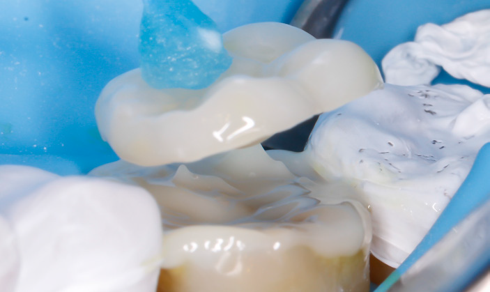 Dental crown being placed on a tooth model with blue-gloved hands visible