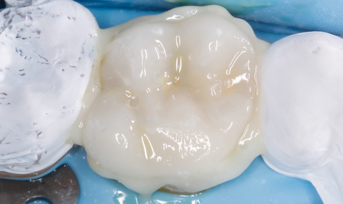 Dental crown being placed on a tooth model with blue-gloved hands visible