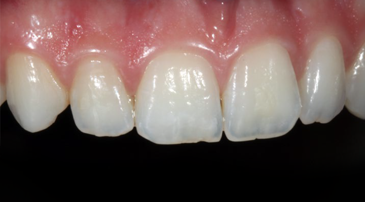 Close-up of upper front teeth and gums showing natural texture and slight translucency
