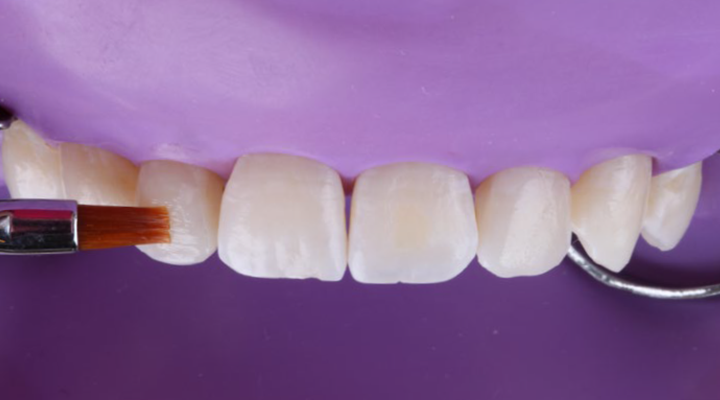 Close-up of dental model with a brush applying material to the front teeth against a purple background