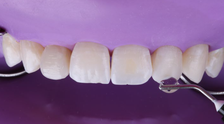 Close-up of upper front teeth with dental tool touching one tooth against a purple background