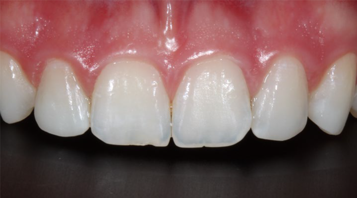 Close-up of upper front teeth showing a small gap between the two central incisors