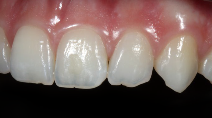 Close-up of upper front teeth and gums showing natural texture and slight irregularities