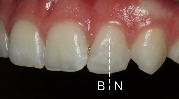 Close-up of upper front teeth with a vertical dashed line between two central incisors labeled 'B' and 'N'