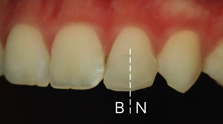 Close-up of upper front teeth with a vertical dashed line dividing a chipped tooth labeled 'N' on the right and intact tooth labeled 'B' on the left