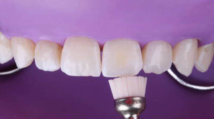 Close-up of upper front teeth with dental brush applying material to the front surface of a central incisor