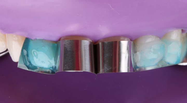 Close-up of four upper front teeth with metal dental matrix bands and blue dental material applied on two teeth against a purple background