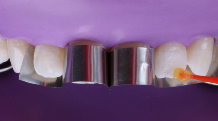 Close-up of upper front teeth with metal dental matrix bands on two central teeth and orange dental material on the right lateral tooth