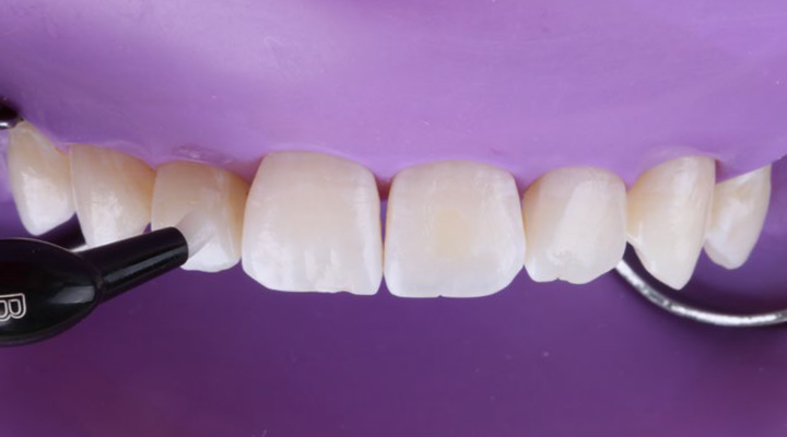 Close-up of upper front teeth with dental tool near left central incisor against purple background
