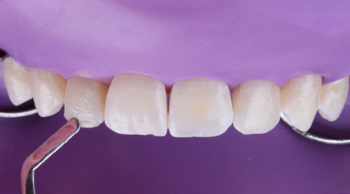 Close-up of dental tools applying material to the front surface of upper front teeth against a purple background