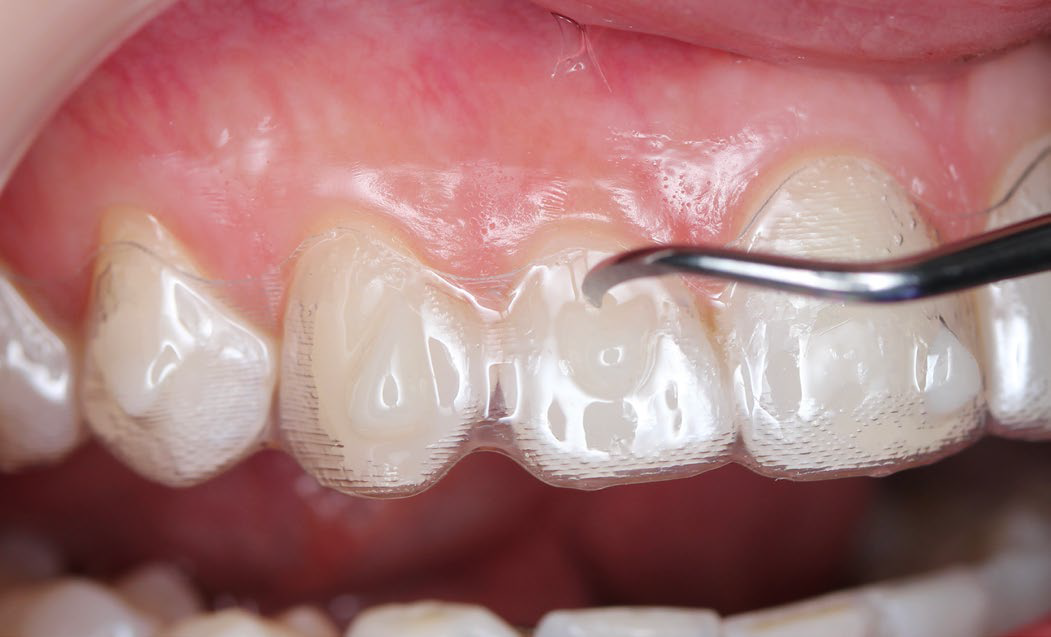 close up of the template being attached to teeth