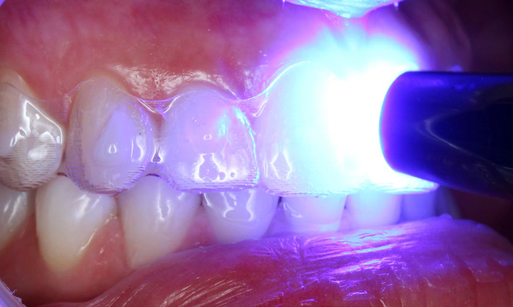 close up of teeth being light cured with light
