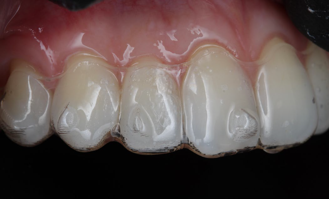 close up of teeth with attachment after cure
