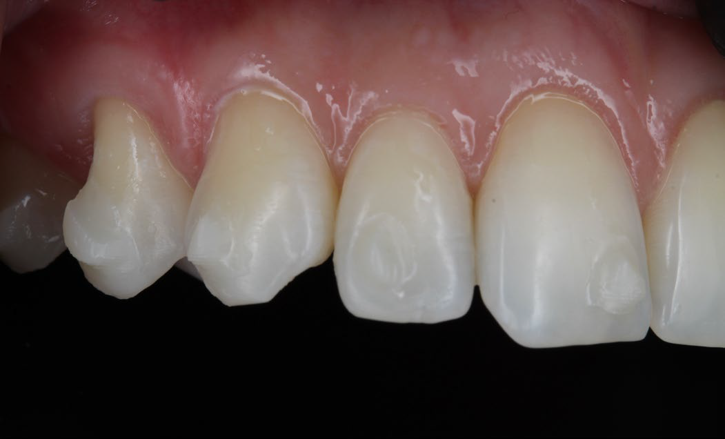 close up of teeth after final polish