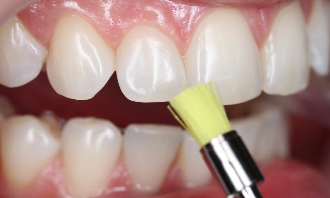 close up of teeth being cleaned and prepared