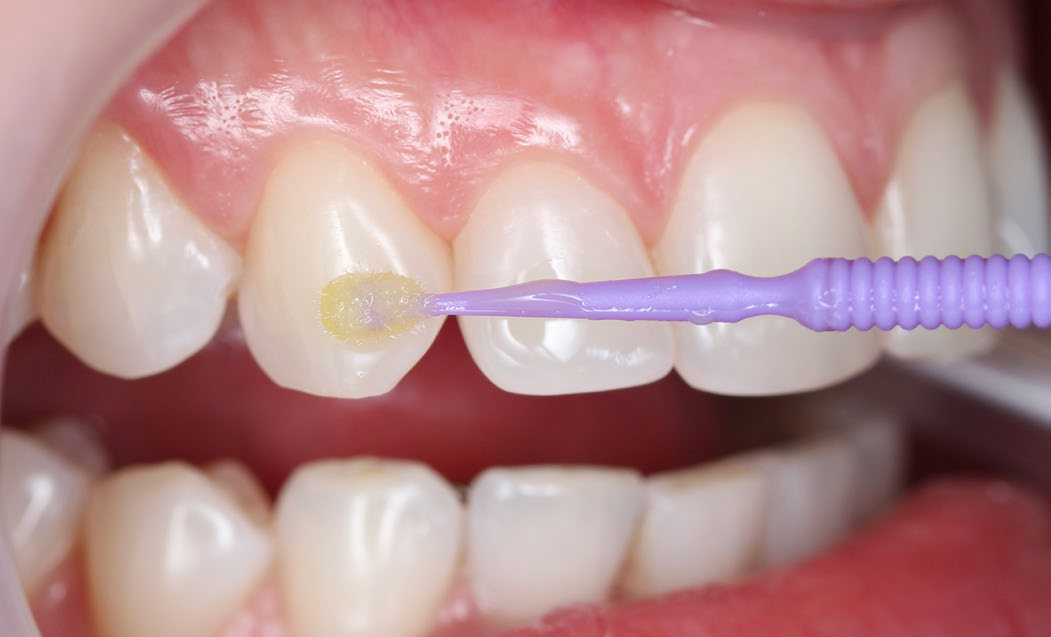 close up of teeth with self etching primer being applied