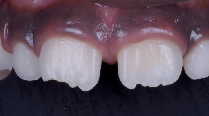Close-up of upper front teeth with a small gap between the two central incisors