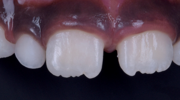 Close-up of three upper front teeth with visible gum line